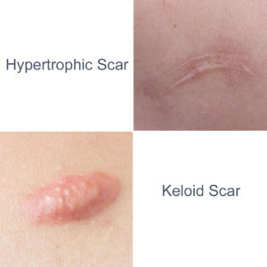 Hypertrophic vs Keloid Scar