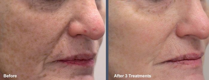 LaseMD Face Before and After Phoenix Scottsdale AZ