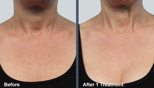 LaseMD Neck Chest Before After