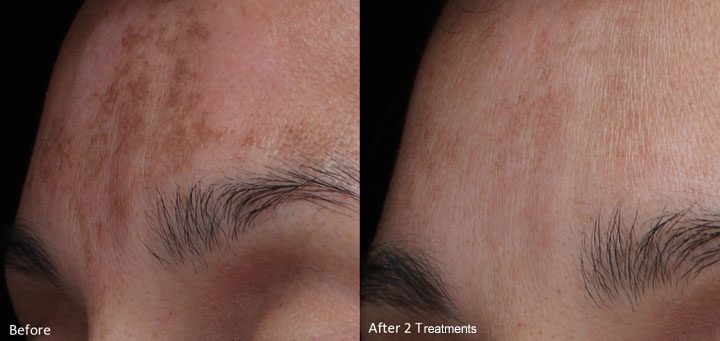 LaseMD for Melasma Treatment at Rejuvience Med Spa
