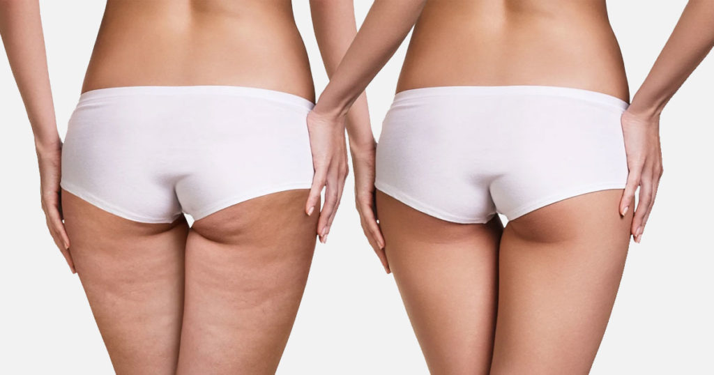 Cellulite Treatment at Rejuvience Med Spa