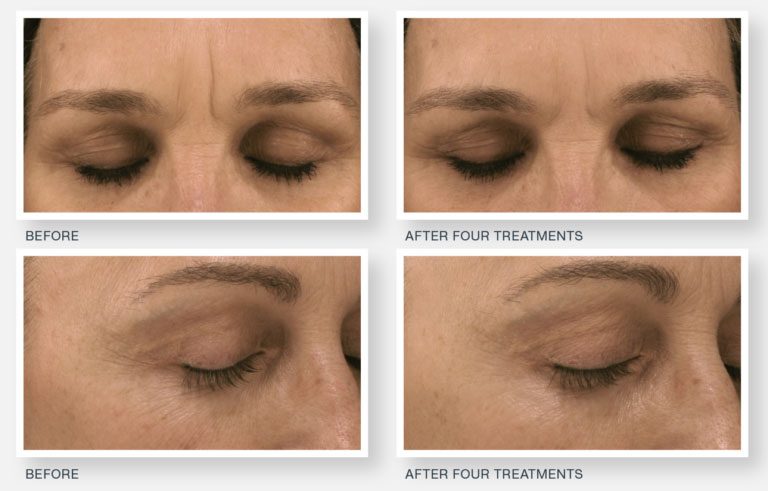 Microneedling Wrinkles Before After Rejuvience Med Spa
