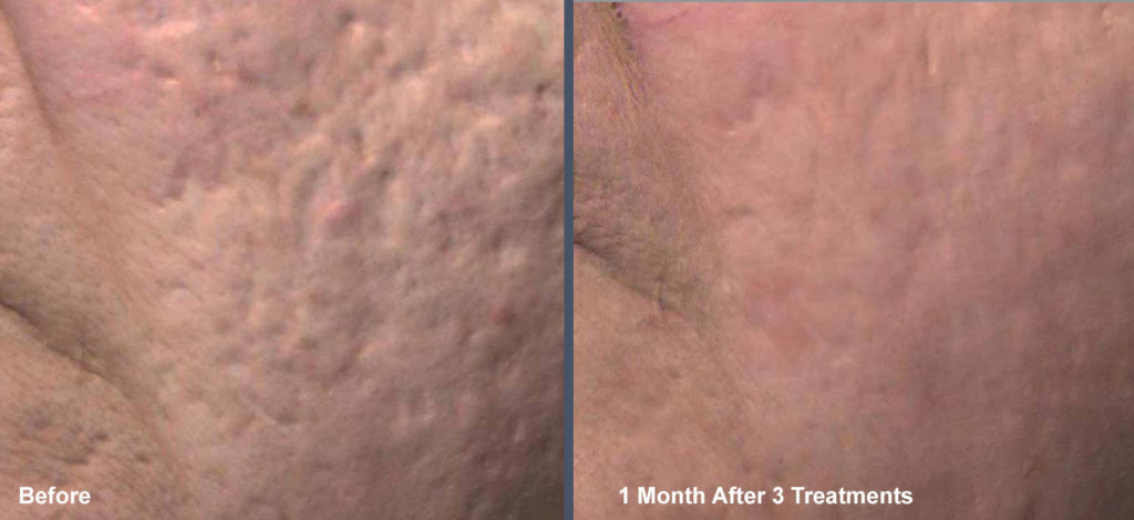 Venus Viva Acne Scars Before and After