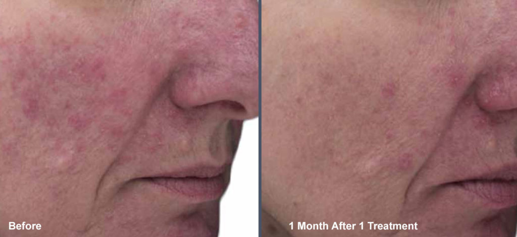 Venus Viva Rosacea Before and After
