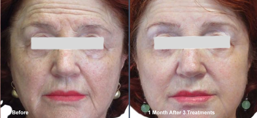 Venus Viva Wrinkle Treatment Before and After