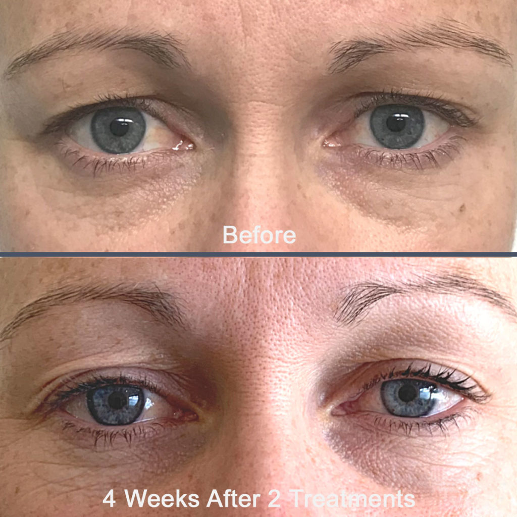 Tixel Eyes Before and After
