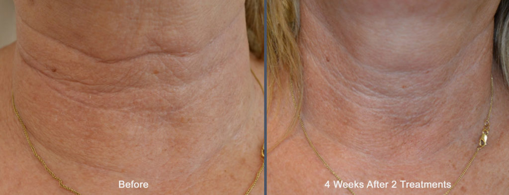 Tixel Neck Before and After