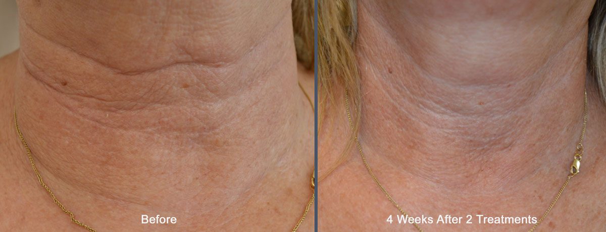 Tixel Skin Treatment | Rejuvience Med Spa Phoenix (602) 899-7462
