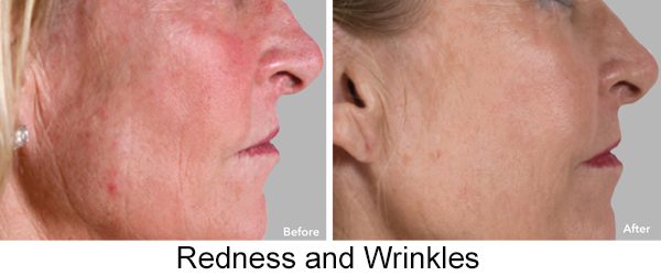 AnteAge MD Wrinkles & Redness