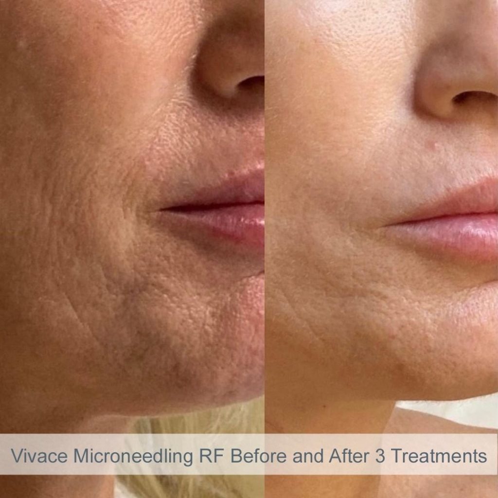 Vivace Before and After 3 Treatments