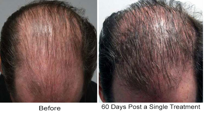 Hair Restoration Men Phoenix Before & After