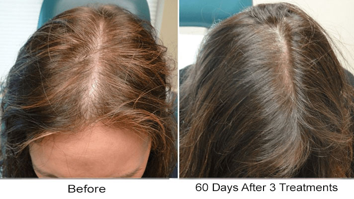Hair Restoration Women Phoenix Before & After