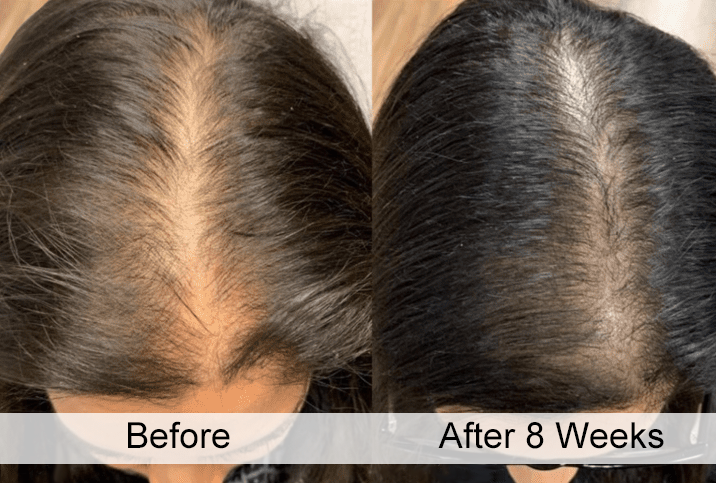 KeraLase Before and After at Rejuvience Med Spa in Scottsdale / Phoenix