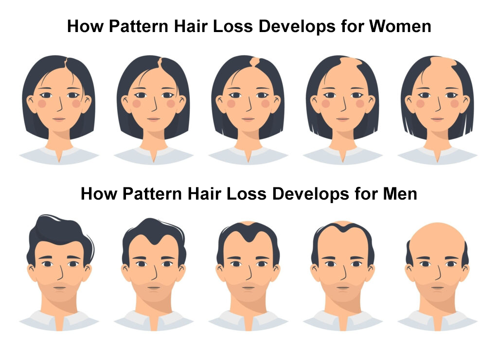 How pattern hair loss develops for men and women