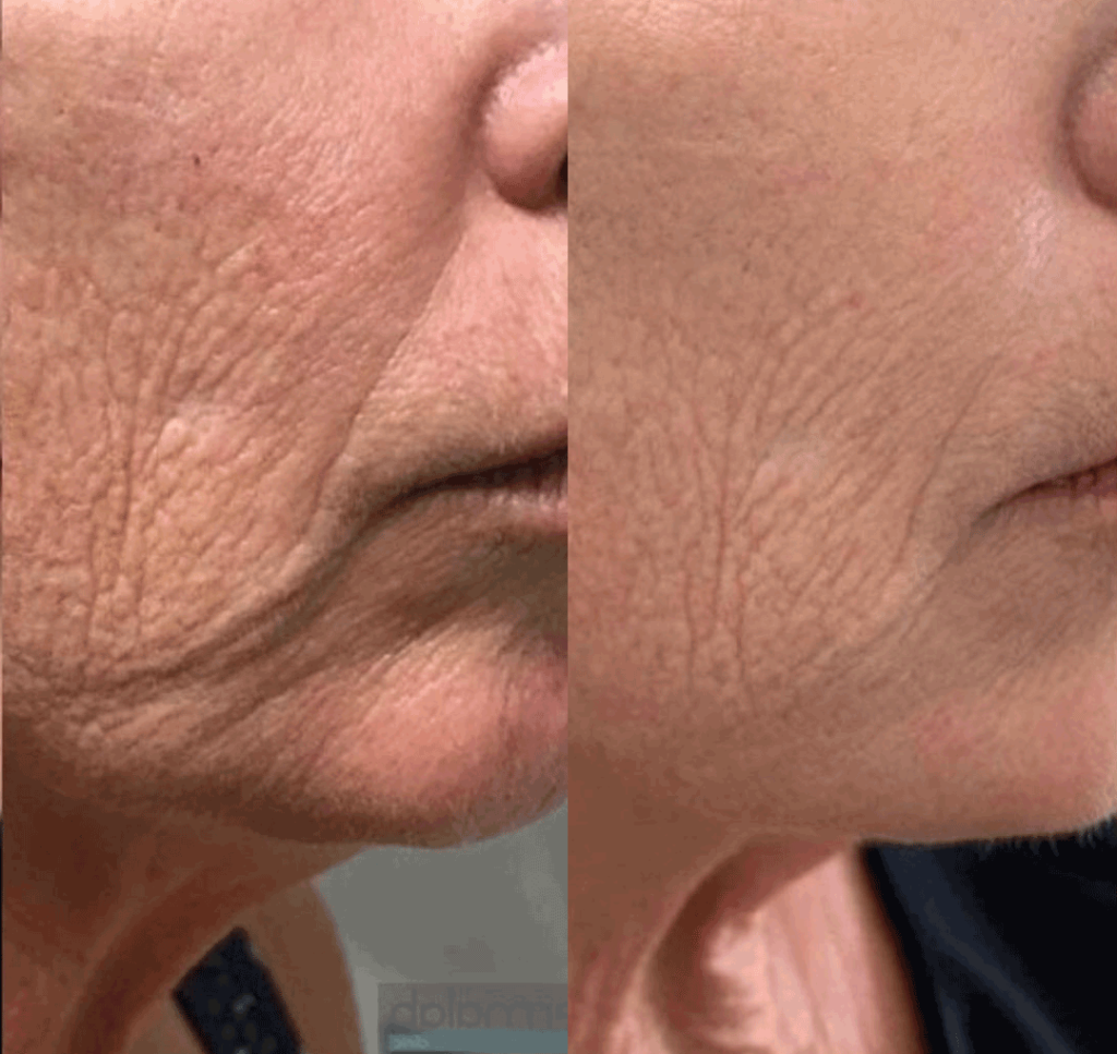 Tixel Skin Rejuvenation Before and After