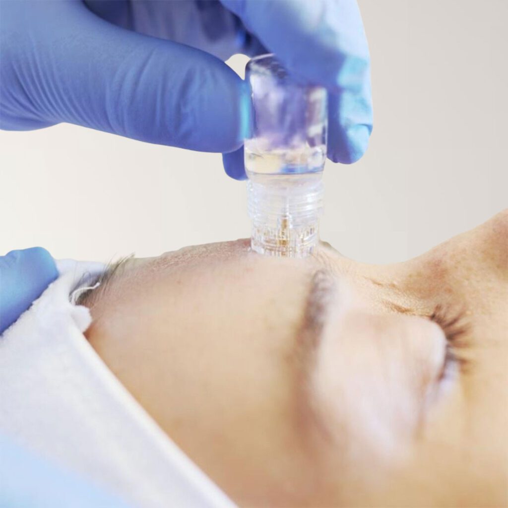 A person receives a stem cell microinfusion facial treatment with a handheld device applied by a gloved hand.