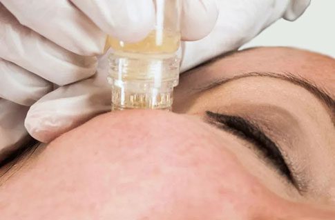 An image of a microinfusion device delivering an exosome microinfusion facial at Rejuvience Med Spa in Scottsdale, Arizona