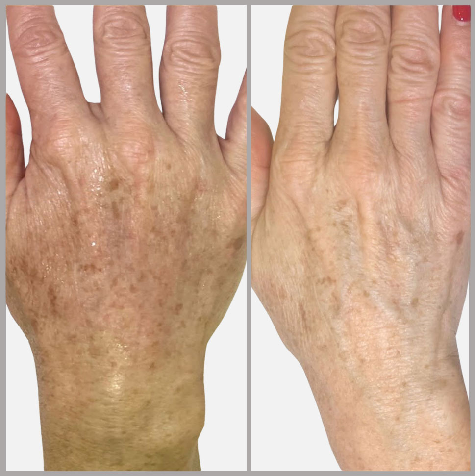 Side-by-side comparison of a hand before and after a hand rejuvenation treatment at Rejuvience Med Spa in Scottsdale, showing reduced dryness and smoother skin texture in the after image.