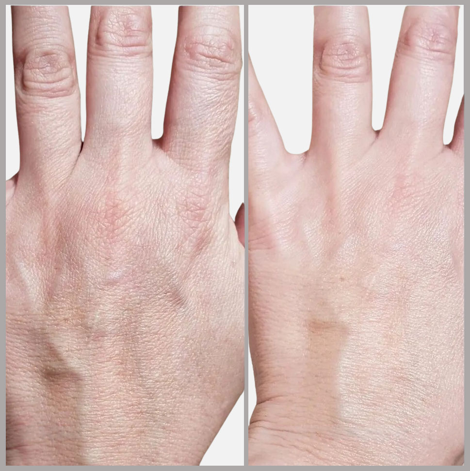 Side-by-side comparison of a hand before and after a hand rejuvenation treatment at Rejuvience Med Spa in Scottsdale, showing reduced dryness and smoother skin texture in the after image.