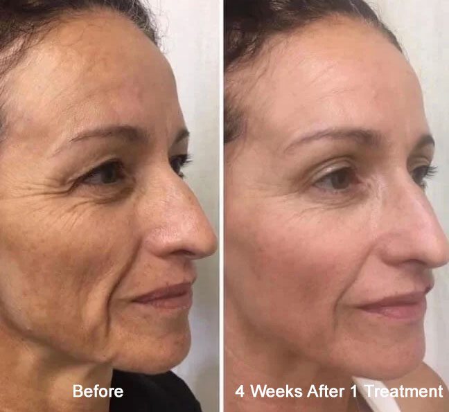 Before and after images of Procell treatment at Rejuvience Med Spa Scottsdale