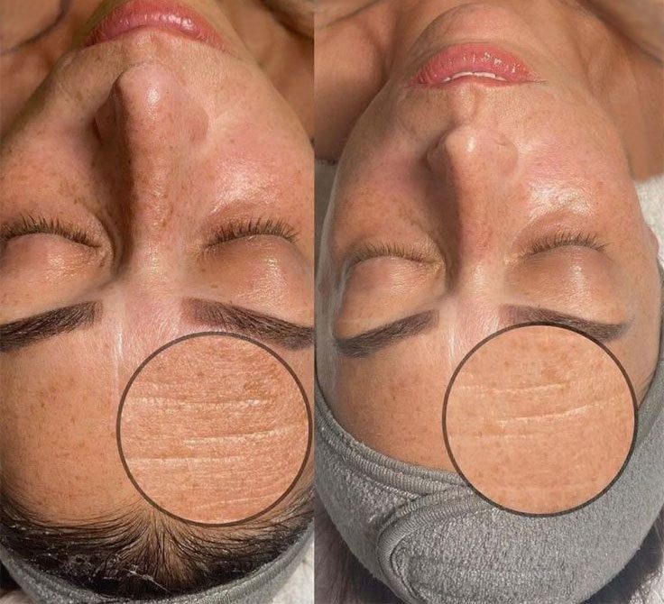 Before & after images of DermaGenesis Facial at Rejuvience Med Spa in Scottsdale