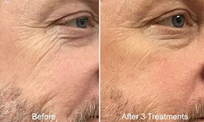 Before and after images of a Rejuvience MCT Treatment Before & After