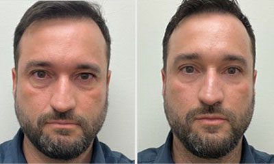 Before and after images of a Rejuvience MCT Treatment Before & After