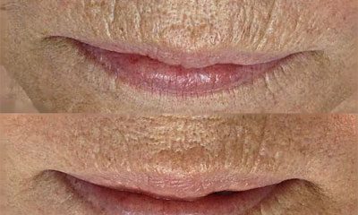 Before and after images of a Rejuvience MCT Treatment Before & After