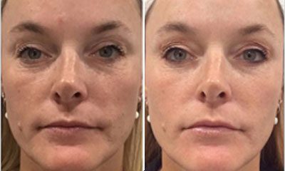 Before and after images of a Rejuvience MCT Treatment Before & After