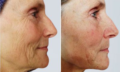 Before and after images of a Rejuvience MCT Treatment Before & After