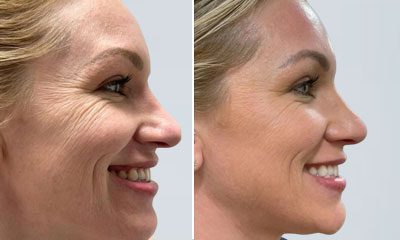 Before and after images of a Rejuvience MCT Treatment Before & After