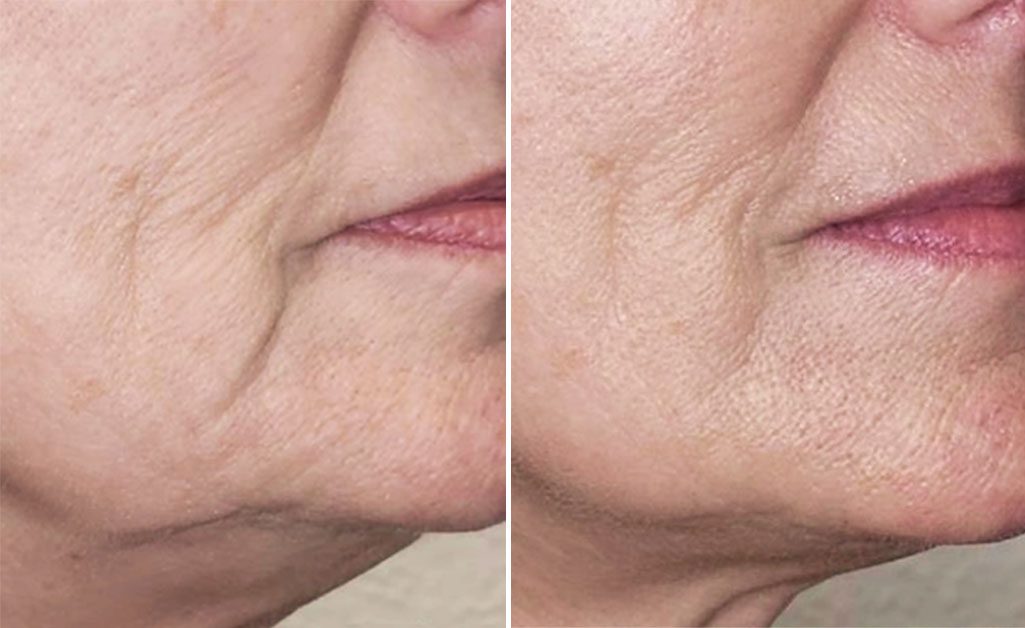 An image of Density RF Skin Tightening for Jowls Before & After at Rejuvience Med Spa Scottsdale