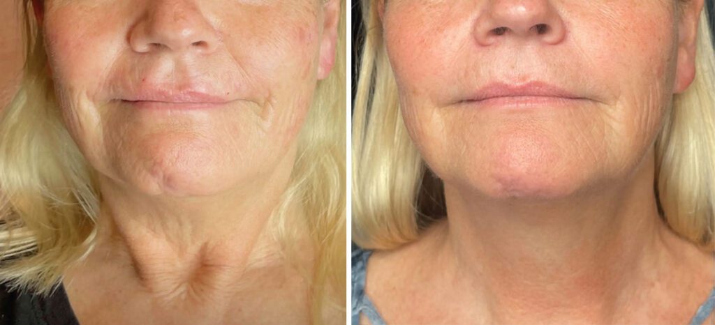 An image Density RF Skin Tightening Midface & Neck B&A at Rejuivence Med Spa in Scottsdale