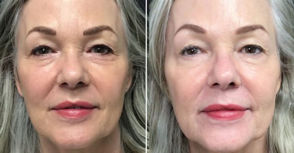 Exosome therapy for face before and after woman 2