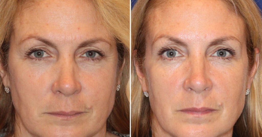 Exosome therapy for face before and after image