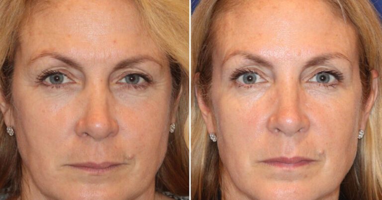 Exosome therapy for face before and after image