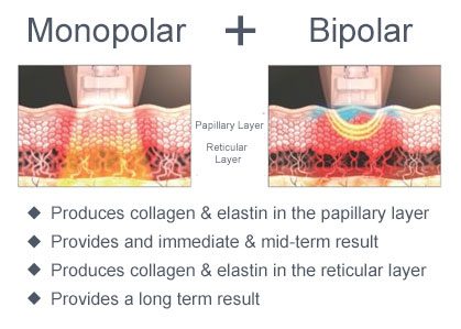 An image describing how Density RF Skin Tightening Works