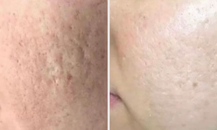 An image of Rejuvience Advanced Regeneratiive Aesthetics Before & After