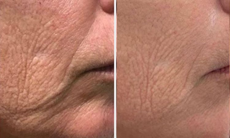 An image of Rejuvience Advanced Regeneratiive Aesthetics Before & After