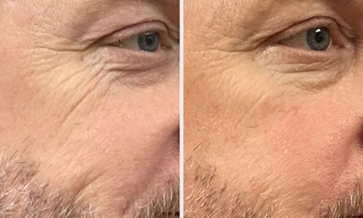 An image of Rejuvience Advanced Regeneratiive Aesthetics Before & After