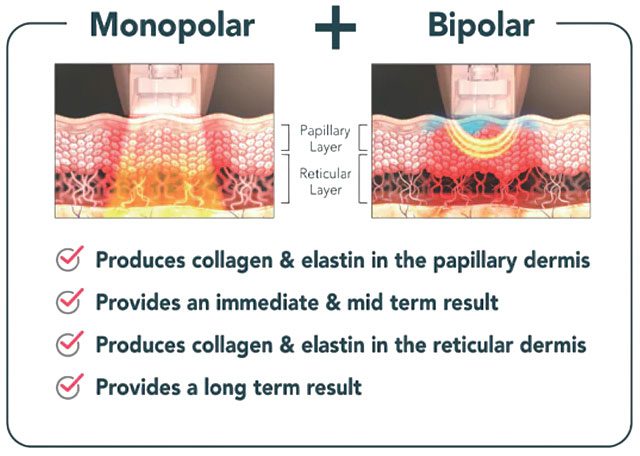 An image documenting the effects of Density RF Mono and Bipolar Energy