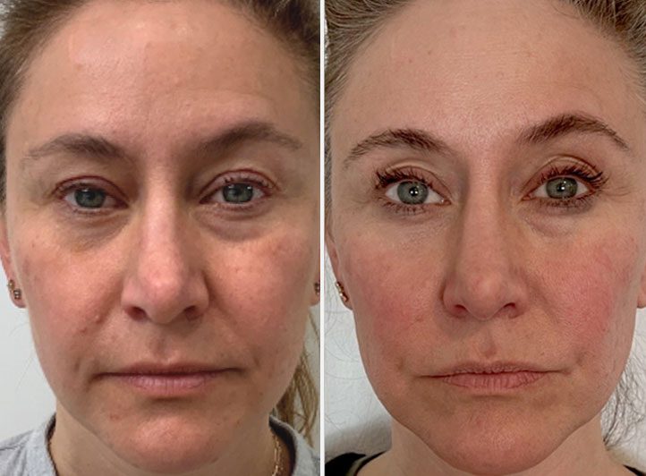 An image of Procell with Exosomes Scottdale Before & After