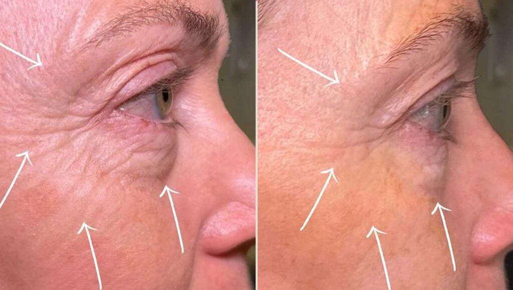 Images of Tixel Non-Surgical Eye Lift Before & After