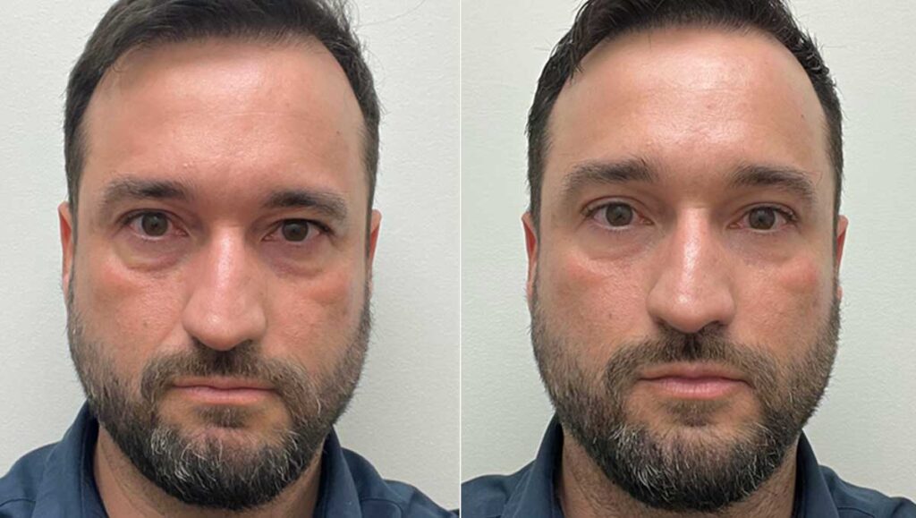 Before and after images of Tixel Skin Resurfacing at Rejuvience Med Spa Scottsdale