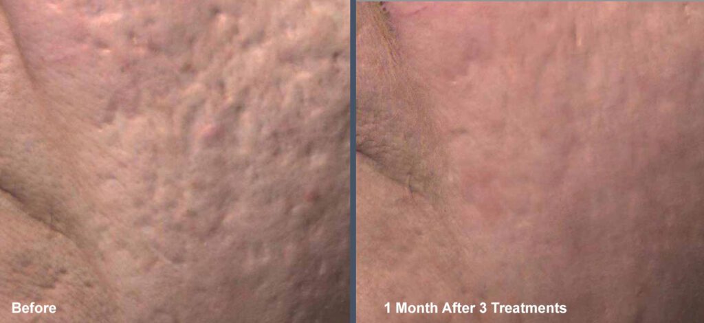 An image of Venus Viva acne scar treatment at Rejuvience Med Spa in Scottsdale before & after