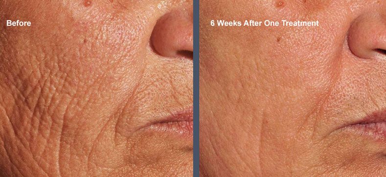 An image of Venus Viva wrinkle treatment at Rejuvience Med Spa in Scottsdale before & after