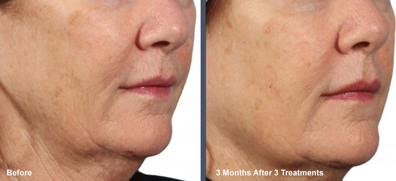 Images of Venus Viva skin volume loss treatment at Rejuvience Med Spa in Scottsdale before & after