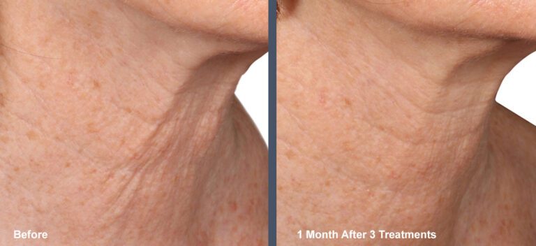 Before & after images of a Venus Viva neck treatment at Rejuvience Med Spa Scottsdale