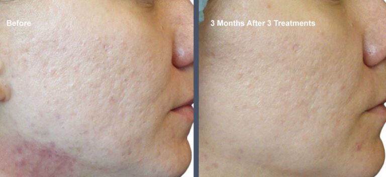 Venus Viva Acne Scars Before and Afters at Rejuvience Med Spa Scottsdale