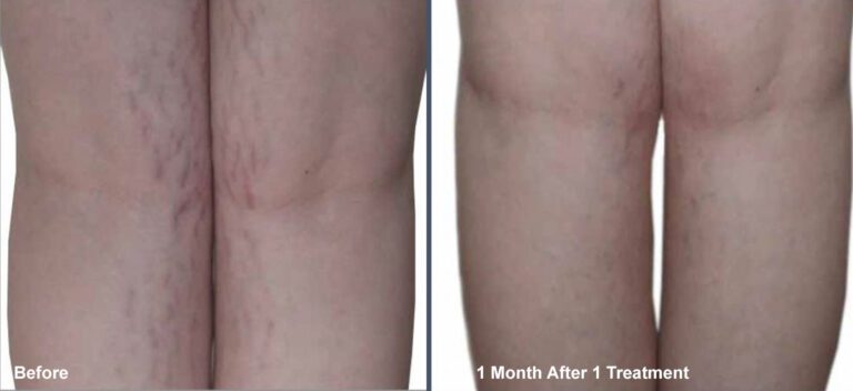 Venus Viva Stretch Mark Treatment Before and Afters at Rejuvience Med Spa Scottsdale